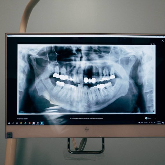 Full X-ray of teeth on HP monitor in a dentist office